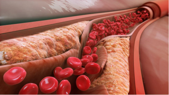动脉硬化是怎样造成的胞倍力清血片帮助软化血管降三高